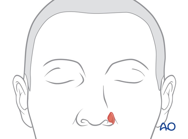 Defecto parcial amplio del ala nasal
