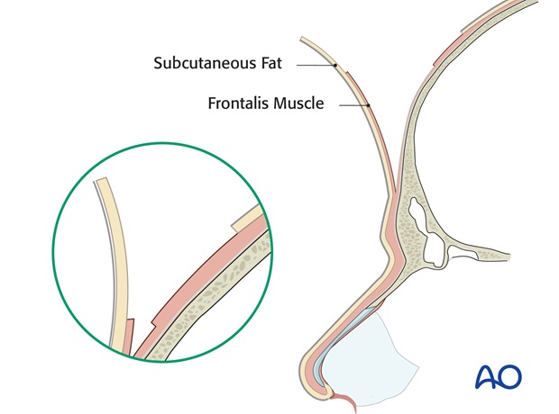 Adelgazamiento distal del colgajo frontal