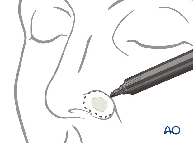 Marcación de los márgenes de resección de un tumor del ala nasal