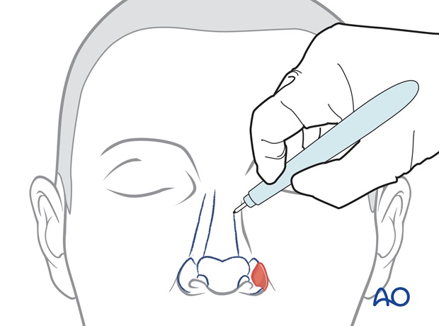 Marcación de las subunidades nasales y faciales