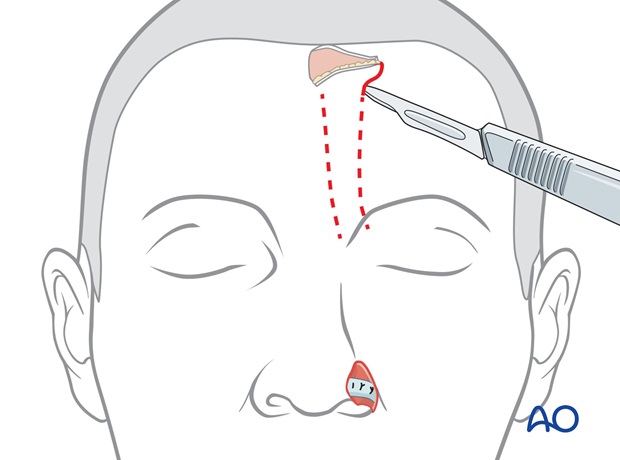 Incisión y adelgazamiento distal del colgajo frontal