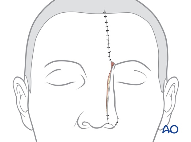 Colocación del colgajo frontal en el defecto nasal