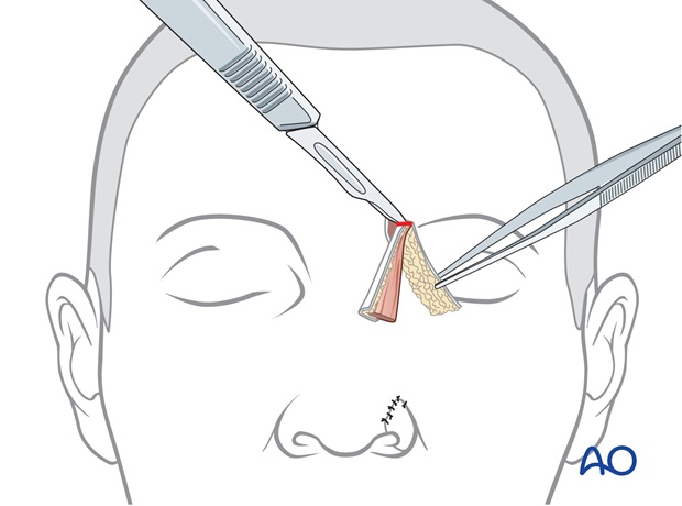 Adelgazamiento del segmento proximal del pedículo frontal